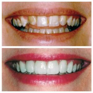 Diseño de Sonrisa en Medellin